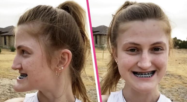 Double Jaw Surgery Transforms Girl — Shocking Before & After