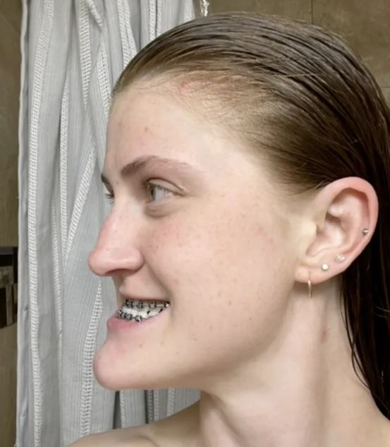 Double Jaw Surgery, Orthognathic Surgery, Transformation Story, Before and After, Confidence Journey, Oral Health, Teen Stories, Personal Growth, Self-Esteem, Dental Surgery,